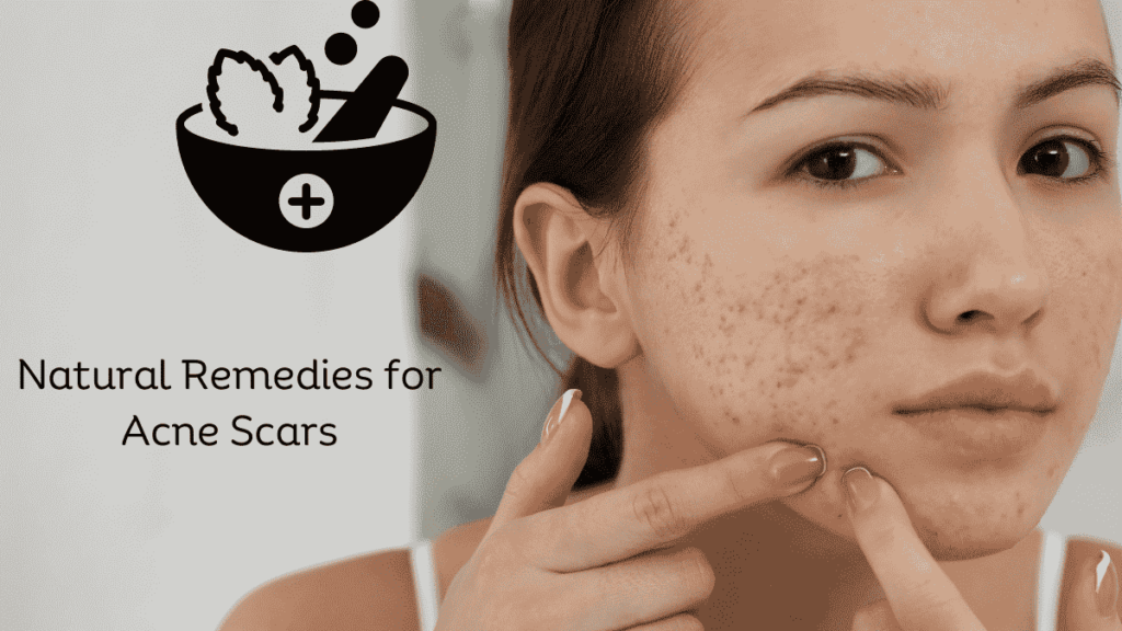 Natural Remedies for Acne Scars